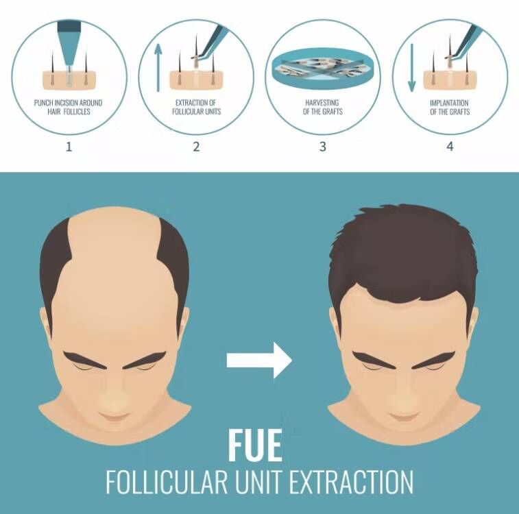ماكينة زرع شعر من FUE-Micro Mo - مراجعة Hair Care Basic وسعره